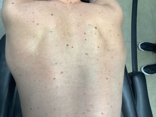 Fitzpatrick Skin Type VI – 9 treatments