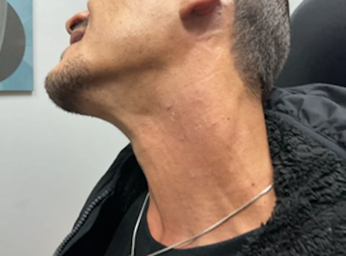 Fitzpatrick Skin Type IV – 12 treatments