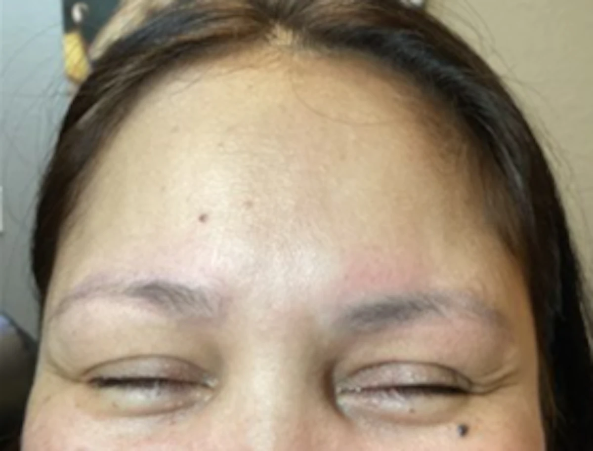 Fitzpatrick Skin Type IV – 1 treatment