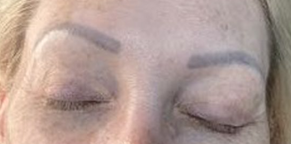 Fitzpatrick Skin Type II – 2 treatments