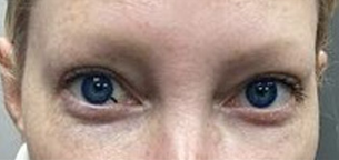 Fitzpatrick Skin Type II – 2 treatments